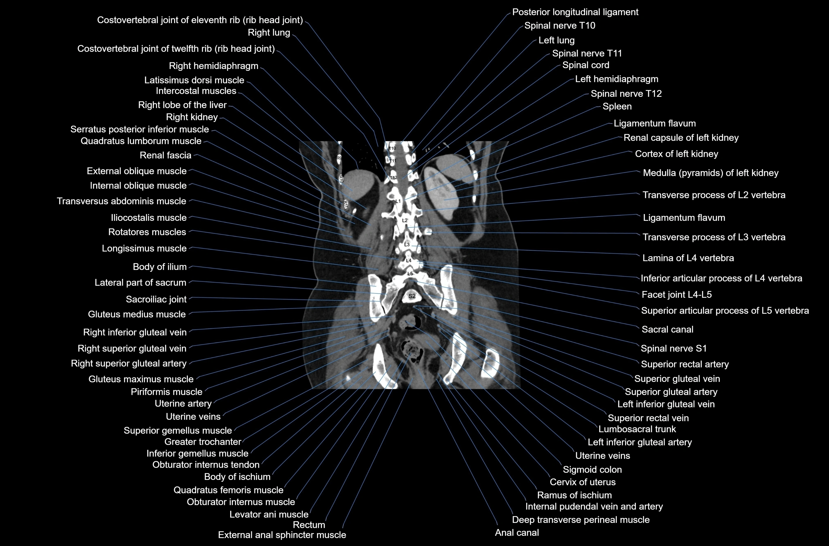 CT abdomen coronal cross sectional anatomy labelled radiology image-00065.webp